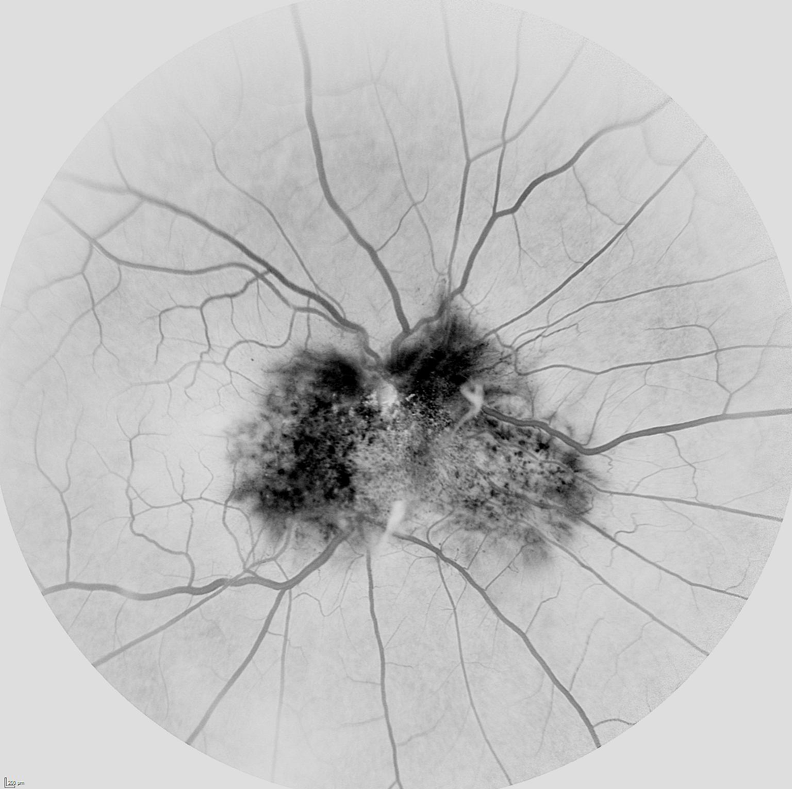 Angiografia fluoresceínica en hamartoma combinado de retina y epitelio pigmentario modo negro sobre blanco